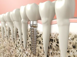 Dental Implantat
